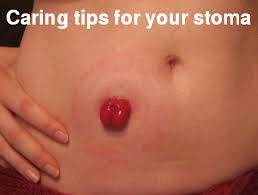 How I Keep My Stoma Free From Infection Colostomy Colostomy Bag Ostomy Care