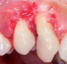 Image result for granuloma gum disease