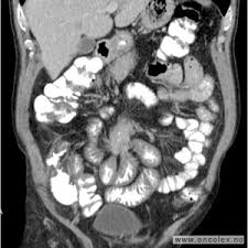 Nå har trine 18 svulster i lungene. Symptomer Ved Nevroendokrine Svulster