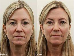 My fears are of looking hollowed or suddenly accentuating under eye lines. Dr Darm Eyelids Before And After T C Eyelid Surgery Laser Eye Surgery Cost Plastic Surgery