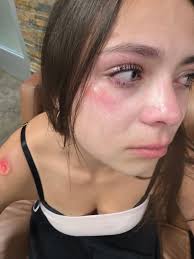 Electric scooter accident