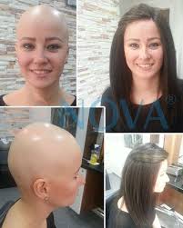 Alopesi Sonrasi Folligraft Uygulamasi Sac Fotograf