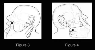 Image result for Jaw Dislocation