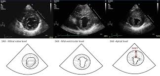 Echocardiography findings in common primary and secondary. Role Of Echocardiography In The Diagnosis And Management Of Hypertrophic Cardiomyopathy Heart