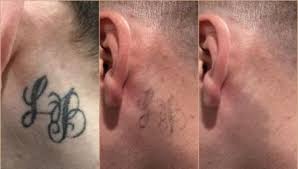 Can i remove my tattoo if i do not like it any longer, and is this effective? Laser Tattoo Removal Before And After In Plymouth Whiteroom Laser Ltd