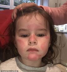 A mum claims her toddler was left screaming that her face was 'burning'  after using Lidl baby lotion