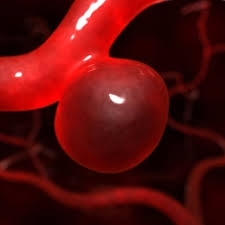 O que é aneurisma cerebral? Aneurisma Caracteristicas De Um Aneurisma Cerebral