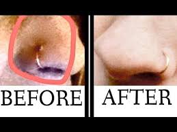 How To Get Rid Of A Keloid Nose Ring Bump Alluringadrianna Nose Piercing Bump Nose Piercing Healing Piercing Bump