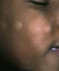 Pityriasis alba is a skin condition, often coexisting with eczema, that is characterized by reduced pigmentation in either light skin patches or thin plaque on the face (mostly cheeks or chin), neck, shoulders, arms and much more. Pityriasis Alba Practice Essentials Background Pathophysiology