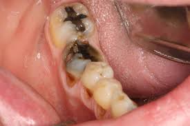 Image result for Tooth Extraction