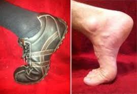 When a person takes a forward step, the heel leaves the ground first, and as this happens, the weight of the. Turf Toe Orthoinfo Aaos