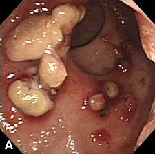 Image result for Neutropenic Colitis