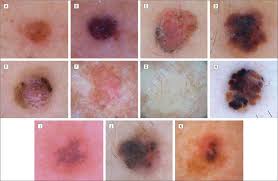 What does melanoma look like? Melanoma Vaccines Creative Biolabs