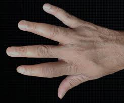 Image result for Dactylitis