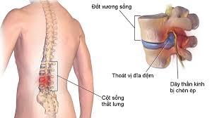 Giải pháp dành cho người mắc bệnh xương khớp