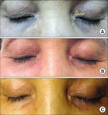 Image result for xanthelasma of eyelid
