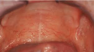 Also, the skin on the roof of my mouth, extending from where the wisdom tooth on the left and right side were, is purple. Jaundice At The Junction Between Hard And Soft Palate Download Scientific Diagram