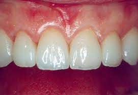 Manahawkin Dentist Porcelain Veneers Ocean Family Dental Porcelain Veneers Dental Cavities Cosmetic Dentist
