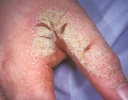 Image result for scabies on humans