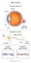 Optic Neuritis: Symptoms, Causes & Treatment Options