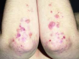 Coxsackieviruses are divided into group a and group b viruses based on early observations of their pathogenicity in neonatal mice. Dermatitis Herpetiformis Duhring Erkrankungen Der Haut Msd Manual Profi Ausgabe