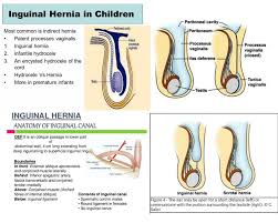 Processes Vaginalis Inguinal Hernia Scrotal Hernia Premature Baby Premature Anatomy