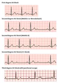 Normally, the sinoatrial node (sa node) produces an electrical signal to control the heart rate. Atrioventricular Block Wikipedia