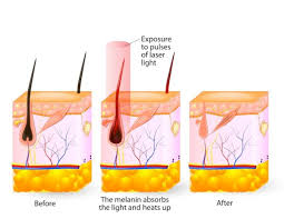 laser hair removal glow medspa