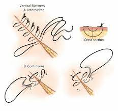 Its disadvantage is a relatively high pr. Vertical Mattress Suturing Results In Better Eversion Of The Tissue And Download Scientific Diagram