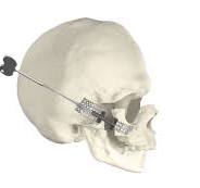 Advanced Midface Distractor | Stryker