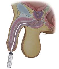 Image result for Retrograde Urethrogram