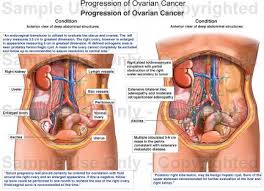 Progression Of Ovarian Cancer Medical Illustration Human