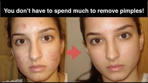Acne get rid, acne how to get rid of, get rid acne, get rid of acne, get rid of pimples. How To Get Rid Of Acne Fast 10 Natural Home Remedies