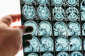 Schadel Hirn Trauma Anzeichen Ursachen Therapie Reha