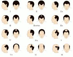 I am an adult and was recently prescribed ritalin for adhd, i am in the hair battle of my life and heard this crap can cause hair loss. Fue Hair Restoration In Toronto Visage Clinic