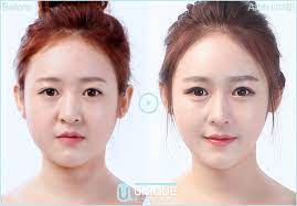 Numbing cream is applied on the area to be corrected. What You Need To Know Before Getting A Nose Job In Korea Jivaka Care