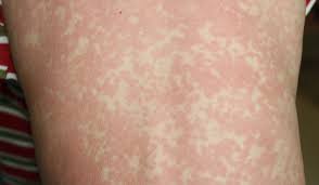 Image result for vyrážka u dětí