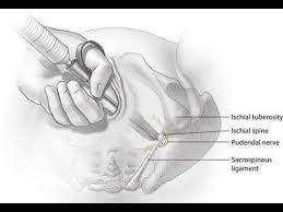 Image result for Pudendal Block