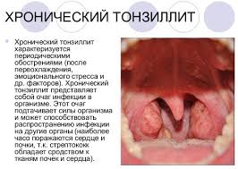 Chem Lechit Gorlo V Domashnih Usloviyah Vse O Lor Zabolevaniyah Yandeks Dzen