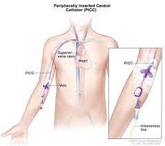 Definition Of Picc - Nci Dictionary Of Cancer Terms - Nci