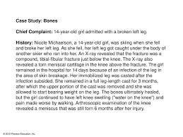 Case Study Bones Chief Complaint 14 Year Old Girl Admitted With A Broken Left Leg History Nicole Michaelson A 14 Year Old Girl Was Skiing When She Ppt Download