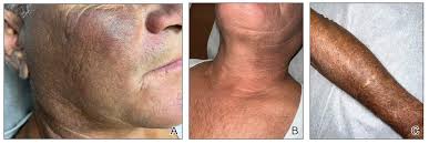 Image result for Diffuse Hyperpigmentation