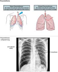 Hemothorax is complicated when compared to pneumothorax as blood enters the pleural cavity. Pneumo Hemothorax Flashcards Quizlet