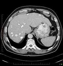 In fact, most people don't even know what it does. Ossifying Hepatic Metastases From Prostatic Carcinoma Radiology Case Radiopaedia Org