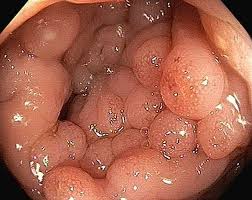 Image result for Microscopic Colitis