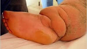 Image result for Filariasis / Penyakit Kaki Gajah