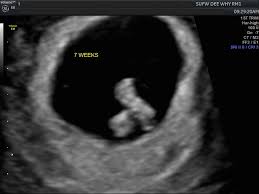 What to expect at your first ultrasound. What To Expect At Your 7 Weeks Pregnancy Ultrasound Baobag