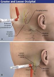 Image result for Forehead Regional Block