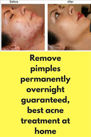 Best Way To Get Rid Of Acne Overnight Find Out How To Remove Pimples Naturally Overnight D How To Remove Pimples Acne Treatment At Home Best Acne Treatment