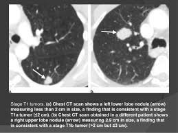 Computed tomography (ct scans) of the chest, on the other hand, are much more powerful cancer signs and symptoms can be vague, from unexplained pain to unintentional weight loss. Lung Cancer Radiology